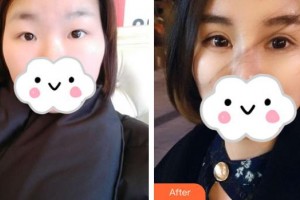 深圳?，斄猪槼毖劭漆t(yī)院范偉整形價(jià)格表附眼部綜合案例展示