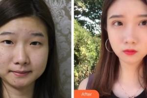 深圳?，斄猪槼毖劭漆t(yī)院林妙麗整形價(jià)格表附眼部整形雙眼皮案例展示