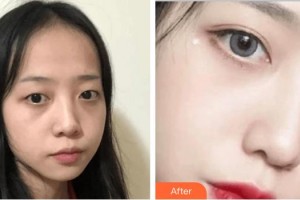 深圳華夏眼科醫(yī)院李春燕整形價(jià)格表附內(nèi)切祛眼袋案例展示