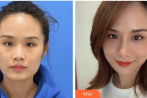深圳華夏眼科醫(yī)院朱少棟整形價(jià)格表附雙眼皮案例展示