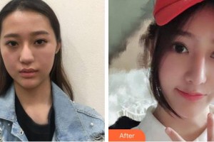 懷化市第一人民醫(yī)院鄧德向整形價(jià)格表附鼻部綜合案例展示