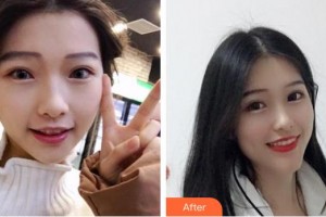 東莞華美醫(yī)療美容醫(yī)院劉江整形價(jià)格表附超聲波潔牙案例展示