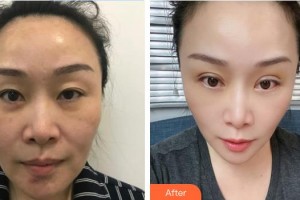 東莞愛(ài)爾眼科醫(yī)院王虎整形價(jià)格表附眼部綜合案例展示