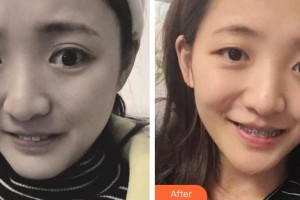 東莞拜爾口腔門診部林金昆整形價格表附牙齒隱形矯正案例展示