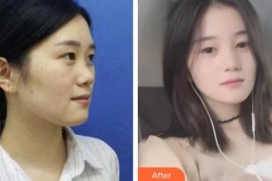 慈溪圣愛(ài)醫(yī)院整形美容科王志忠整形價(jià)格表附鼻部綜合案例展示