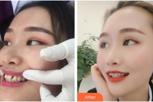 陽春口腔醫(yī)院黃廣柱整形價(jià)格表附隱形托槽矯正案例展示