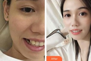 陽春口腔醫(yī)院陳賢文整形價(jià)格表附金屬托槽矯正案例展示