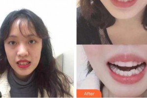 陽春口腔醫(yī)院盧東曉整形價(jià)格表附牙齒隱形矯正例展示