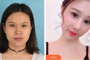 興義時光整形美容醫(yī)院劉凱整形價格表附鼻部綜合案例展示
