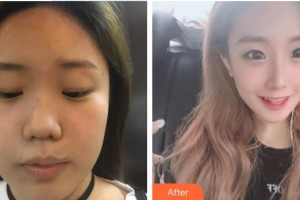 河源曙光醫(yī)療美容門診部王海龍整形價格表附隆鼻案例展示