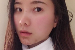 鄭州美立方醫(yī)院怎么樣？熱瑪吉2021價(jià)格分享附案例