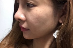 邵逸夫醫(yī)院環(huán)境怎么樣？熱瑪吉價格表和術(shù)后果