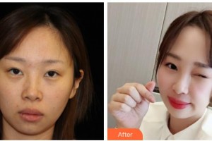 西南醫(yī)科大學(xué)附屬醫(yī)院整形燒傷外科丁曉斌整形價格表附熱瑪吉案例展示