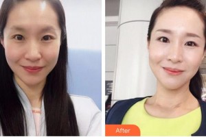 瀏陽康美醫(yī)療美容門診部鄒笑寒整形價格表附嗨體去頸紋案例展示