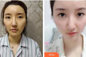 瀏陽康美醫(yī)療美容門診部杜亞妮整形價格表除皺案例展示