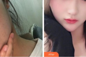 李國偉整形價格表附激光美膚激光案例展示