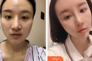 江天明整形價(jià)格表附肋軟骨隆鼻案例展示