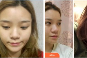 渭南海成皮膚專科醫(yī)院韓海成整形價(jià)格表附熱拉提案例展示