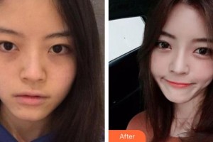 浦江縣亞芳皮膚美容整形門診部陳燕鶯住院醫(yī)師整形價(jià)格表附埋線提升案例展示
