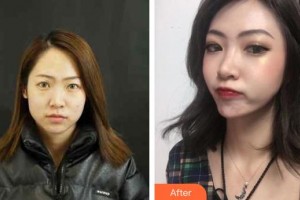 中山愛思特美容醫(yī)院　張朝凱整形價(jià)格表附鼻部綜合案例展示