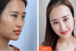 揭陽華美整形美容醫(yī)院魯利兵整形價(jià)格表附超聲波潔牙案例展示