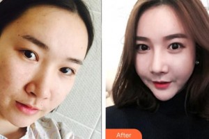 林潔靈住院醫(yī)師整形價(jià)格表附埋線提升案例展示