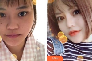 沭陽縣人民醫(yī)院皮膚整形美容科陶士陽整形價(jià)格表附鼻部綜合案例展示