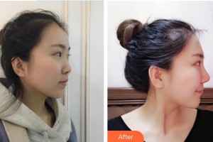 沭陽縣人民醫(yī)院皮膚整形美容科張磊整形價(jià)格表附假體隆鼻案例展示