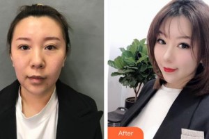 廣州塑妍醫(yī)療美容門診部陶毅整形價(jià)格表附埋線提升案例展示