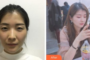普洱云美婦產(chǎn)醫(yī)院醫(yī)療美容科文小燕整形價格表附微針?biāo)獍咐故?>
</a>
<h3 class=