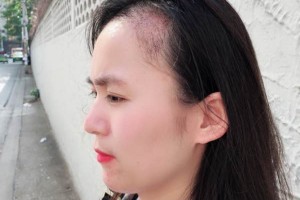 廣西醫(yī)科大一附院有稙發(fā)嗎？附發(fā)際線(xiàn)種植果圖