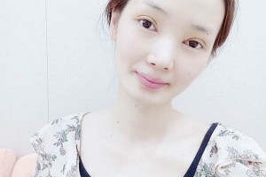 山東集美整形醫(yī)院雙眼皮手術(shù)果展示 附收費標(biāo)準