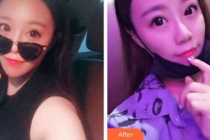 徐佳明整形價格表附射頻緊膚案例展示