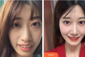 曹燕妮整形價格表附牙齒陶瓷矯正案例展示