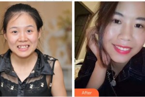 李建整形價格表附自鎖托槽矯正案例展示