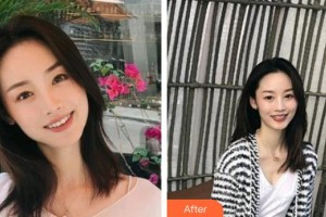 羅在德整形價格表附金屬托槽矯正案例展示