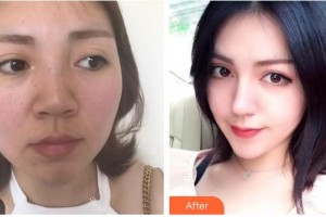 袁鹿鹿整形價格表附鼻部綜合案例展示