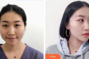 陳鳳霞整形價格表附肋軟骨隆鼻案例展示