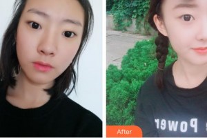佘曉龍整形價格表附鼻部綜合案例展示