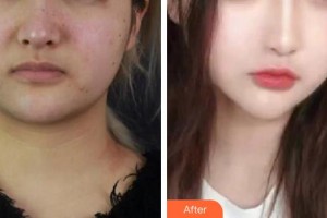 趙靜達整形價格表附鼻部綜合案例展示