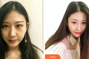 新鋼中心醫(yī)院燒傷整形科胡衛(wèi)東整形價格表附鼻部綜合案例展示