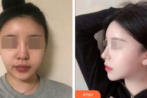 張立春整形價格表附鼻部綜合案例展示