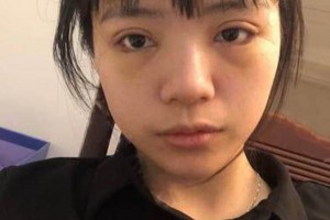 廈門海峽整形醫(yī)院雙眼皮果？附果圖及案例展示