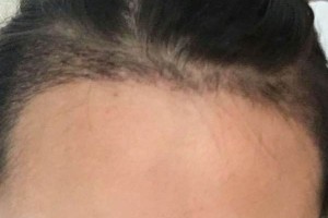 北京同仁醫(yī)院整形美容外科怎么樣？（附果圖）