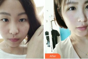 石首華美整形醫(yī)院楊若國整形價格表附眼部案例展示