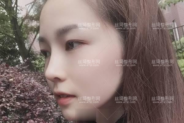西安市第四醫(yī)院美容科價格表公布隆鼻3個月果|整形專家詳情