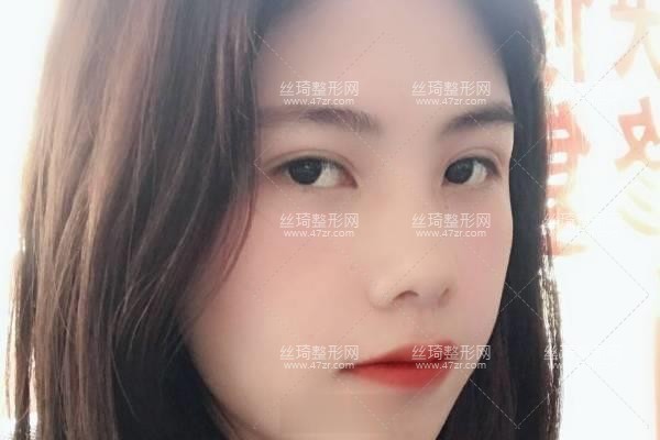 上海九院怎么樣？雙眼皮3個月果|整形專家詳情