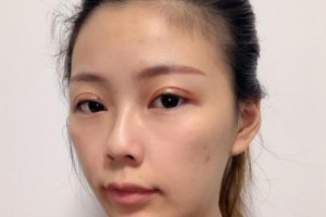 南方醫(yī)院苗勇植發(fā)果好不好？真實案例分享