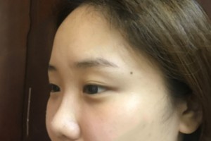 武漢協(xié)和醫(yī)院美容科怎么樣 ？去眼袋果圖
