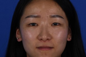 上海伊萊美容醫(yī)院口碑怎么樣？雙眼皮案例對(duì)比圖